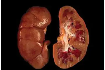 Üremi Belirtileri ve Tedavisi