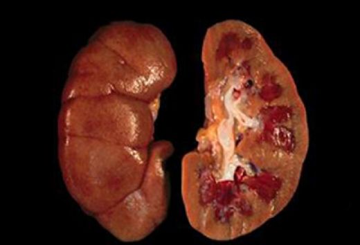 Üremi Belirtileri ve Tedavisi